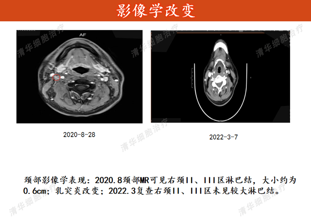 非角化型鳞状细胞癌的药物治疗