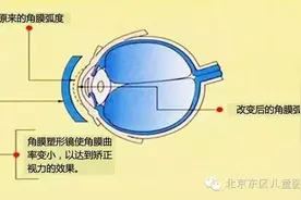 角膜塑形镜(OK镜)预防近视的优缺点和适用人群图片