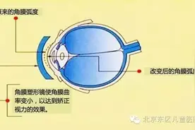 角膜塑形镜(OK镜)预防近视的优缺点和适用人群图片