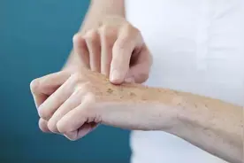 人为何会长老人斑？用红霉素软膏能去除吗？看完涨知识了图片