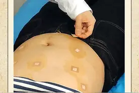 中医埋线减肥要注意什么？看完就知道！图片