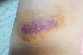 擦伤磕伤后大家是怎么处理的？图片