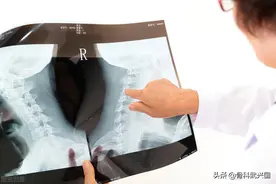 骨刺的非手术治疗有哪些方法？图片