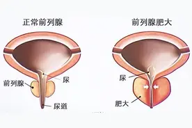 男人的生命“腺”——前列腺增生了怎么办？图片