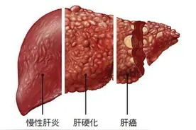 警惕肝硬化的10个信号，发现1个，赶紧检查，再拖就没命了！图片
