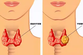 葡萄，对甲状腺是好是坏呢？医生：保护甲功，“4果”建议少碰图片