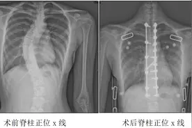 哈医大一院群力骨科一病房助脊柱畸形青少年重拾健康自信图片