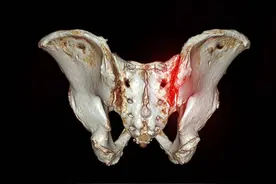 骶髂关节痛的临床表现和诊断图片