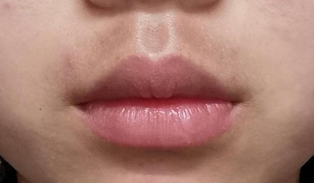 嘴唇边缘发黑怎么办