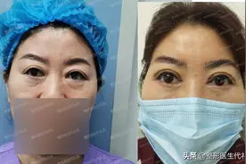 作为一名60岁做全切双眼皮+外切眼袋的过来人，说说我的术后感受图片