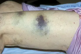 警惕人传人！母子接连病倒，1人去世图片