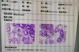萎缩性胃炎伴肠化，42岁男子，6个月萎缩肠化没了图片