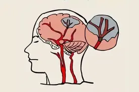 中风和脑梗的区别，很多人都分不清，别不当回事图片