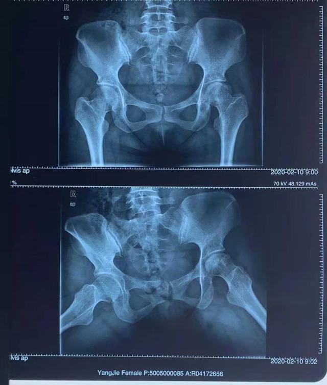 股骨头III期坏死能不能痊愈?需迈过这4道门槛,要不步入塌陷深渊