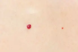 身上突然出现这种小红点，是肝出现了问题吗？图片