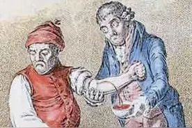 300多年前的放血疗法荒诞至极图片