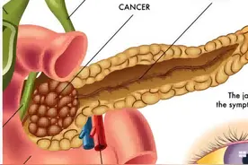 胰腺占位=胰腺癌？图片