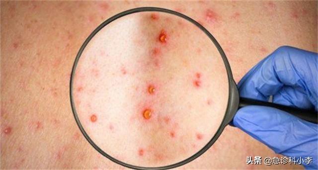 手上长了很多小红点