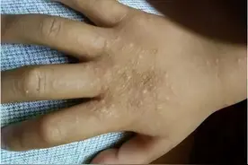 夏天孩子身上常见的几种小疙瘩，再痒也别抠，小心越来越多图片