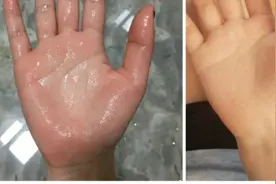 手汗症不是大病不需要处理？别让孩子的人生留下遗憾图片