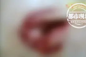 7岁男孩脸被“窜天猴”炸伤脸颊，过年时一定小心！图片