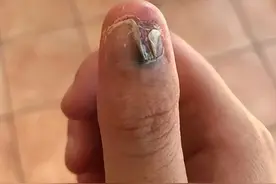 啃指甲啃出皮肤癌？从小“咬指甲”的孩子，长大后会怎么样？图片