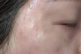 春季面部干燥，刺痒？防治春敏这样做！图片