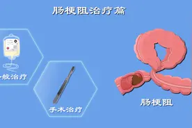 肠梗阻要断水绝食？肠道堵塞咋疏通？肠梗阻治疗门道多图片