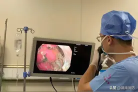 1岁男童误吞5枚电池超10小时！出现严重胃粘膜糜烂！图片