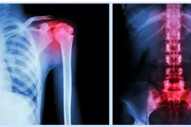 老人骨折了做手术就够了吗？骨科医生详解图片