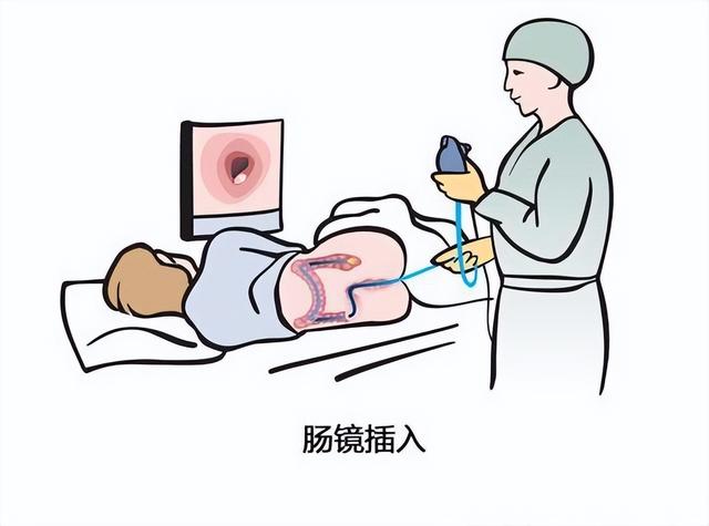 做一次肠镜,"有效期"可维持多久?医生揭晓答案,看完涨知识了