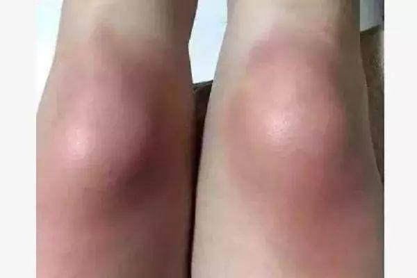 滑膜炎膝盖积水蕞佳治疗方法？