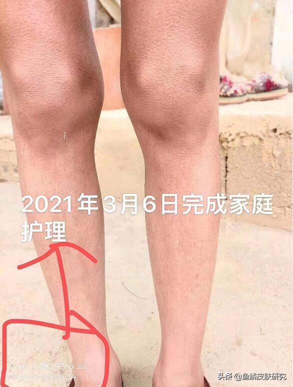 鱼鳞病跟鸡皮肤是一样的时候吗