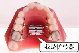 牙齿矫正什么是“扩弓”？会让脸型变大吗？图片