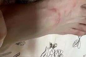 花了7400元买的Gucci女鞋 穿了3次才一个多礼拜就“脱底”！年轻妹子的脚背布满水泡……图片