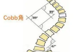 脊柱侧弯已纳入学生体检！家长们一定不要忽视孩子的这个问题图片