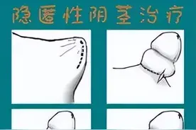 “鸡鸡”太迷你，长不大，怎么回事？图片