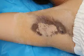 为什么做了狐臭手术后还有味道呢？图片