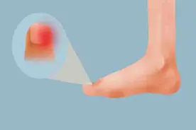 指甲长到肉里面，甲沟炎到底有多痛？得了甲沟炎，只能拔除吗？图片