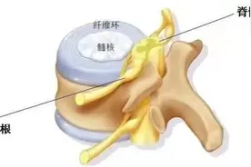 颈椎的硬膜囊受压，这个严重吗？图片