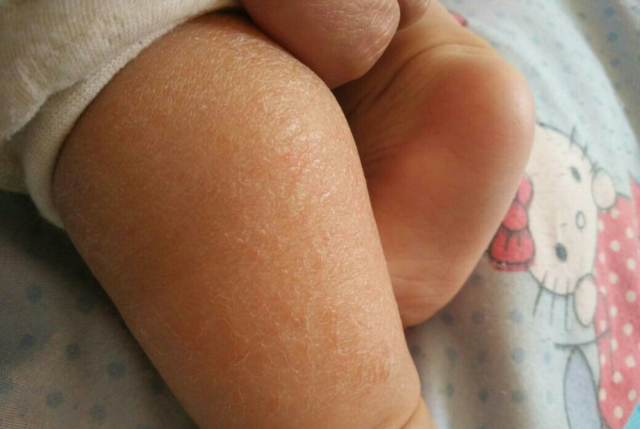 婴儿皮肤干燥用身体乳吗