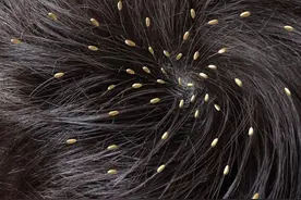 虱子：远古而来，30年前农村男女身上几乎都有，今为何几近绝迹？图片