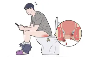 大便带血，是痔还是癌？图片