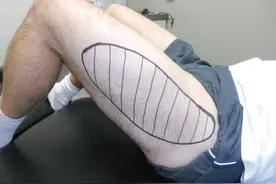 单纯大腿前外侧麻木、烧灼感，怎么办？图片