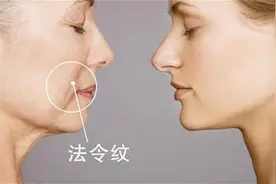 爱美丽嘉玺法令纹的形成原因有哪些？图片