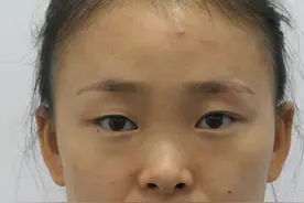 27岁“塌鼻子”女孩奔赴北京，做完鼻整形7个月后，开启自信人生图片
