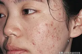 青少年常见痤疮(青春刺)的中医辨证治疗图片