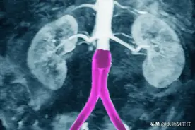 做完冠脉造影，患者就活不久了？冠脉造影检查对人体有什么危害？图片
