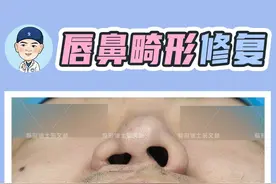 唇（腭）裂修复术后鼻子塌陷，能用父母的软骨吗？图片