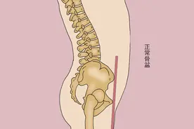 骨盆骨折有哪几种？该如何诊断和治疗？一文解释清楚图片